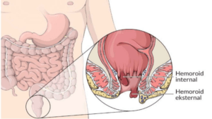 Tuvalette telefon alışkanlığı hemoroid sebebi olabilir. Uzmanlar, tuvalete telefonla gitme